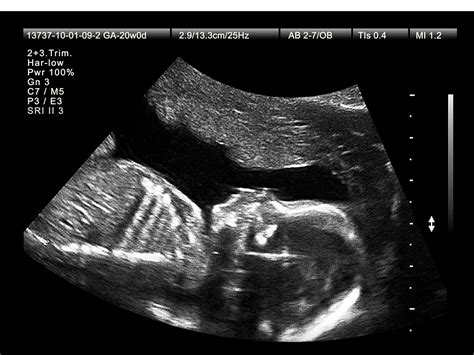 What To Expect At Your 20 Week Ultrasound Appointment