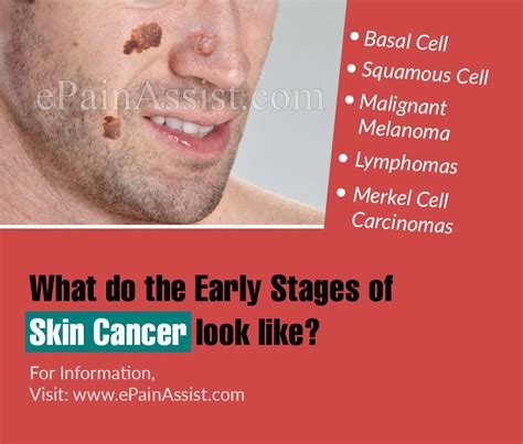 Early Stage Skin Cancer Signs And Symptoms Steve