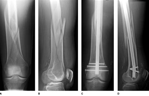 Distal Femur Fracture Before And After Surgery Imhs Rod With Screws