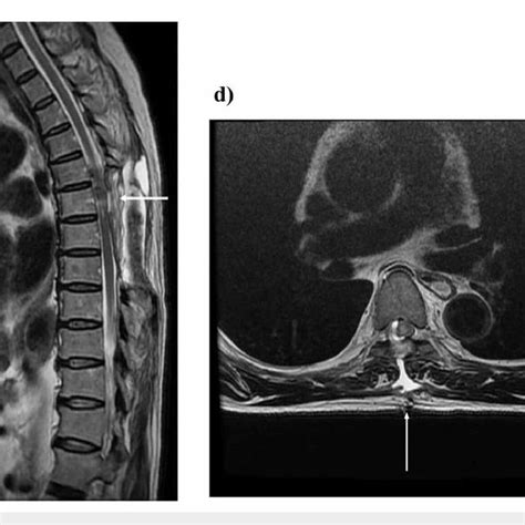 Thoracic Spine Intradural Extramedullary Tumor Th6 Postoperative