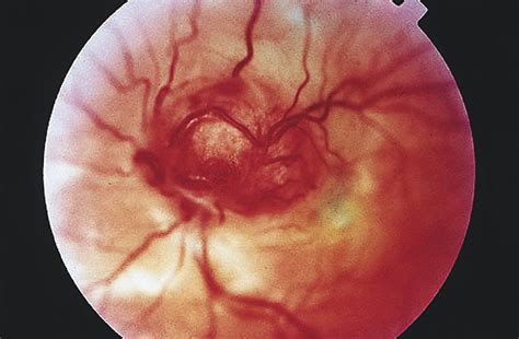 Capillary Hemangioma Of The Optic Nerve Head And Juxtapapillary Retina