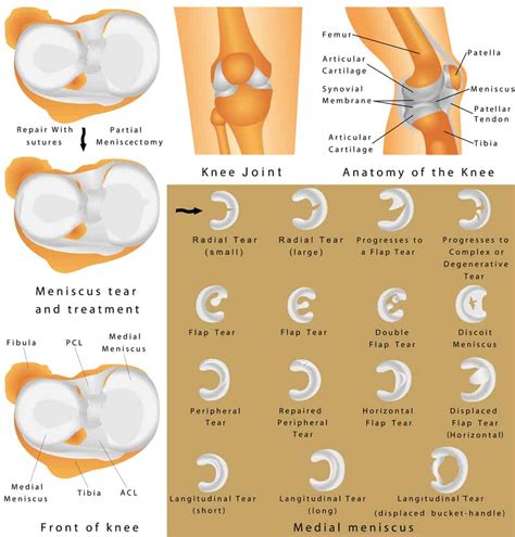 The Three Most Common Symptoms Of Knee Meniscal Tears