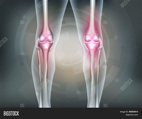 Human Legs Knee Joint Vector And Photo Free Trial Bigstock