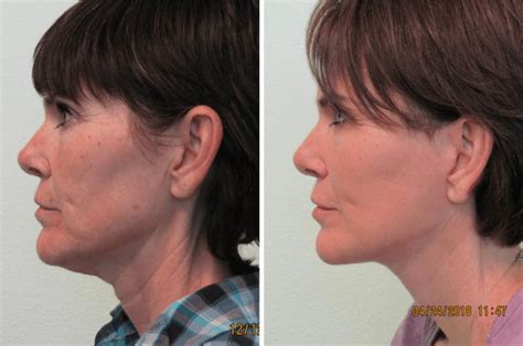 Best Treatment For Sagging Neck And Jowls 2020 Australia Get More