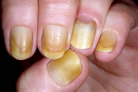 12 Changes In Your Fingernails That Could Signal Other Problems