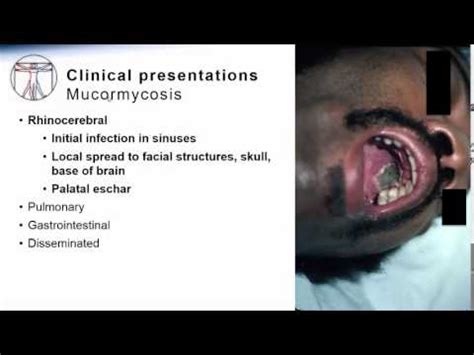 What is mucormycosis, the fungal infection affecting covid patients in india? Mucormycosis - YouTube
