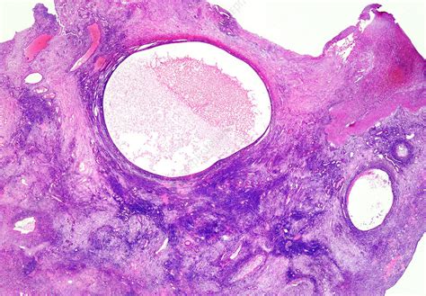 Human Ovary Cysts Light Micrograph Stock Image C0487045 Science
