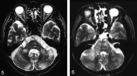 Mr Features Of Diseases Involving Bilateral Middle Cerebellar Peduncles