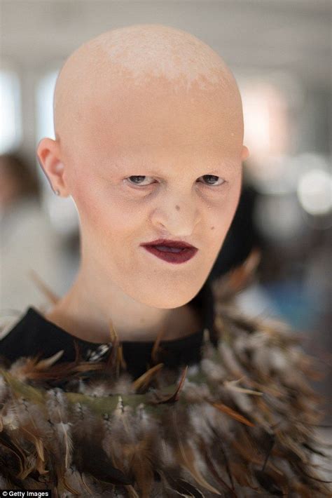 Melanie Gaydos Model With Genetic Disorder Storms Fashion Industry