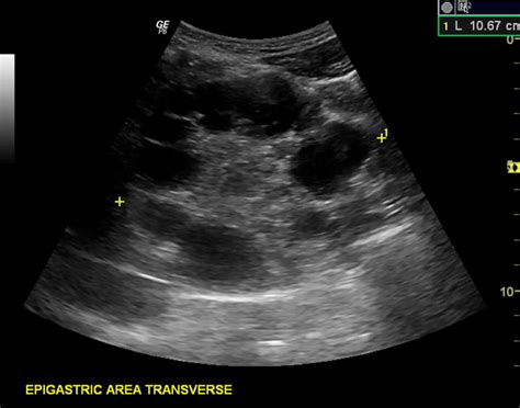 Conservative surgeries remain the most common methods used in the treatment of cyst hydatid. Hydatid cyst causes, symptoms, diagnosis, treatment ...