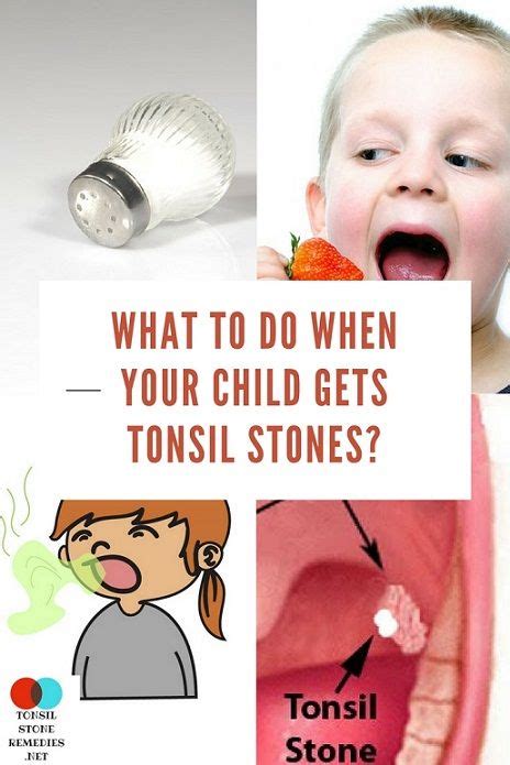 What To Do When Your Child Gets Tonsil Stones Tonsil Stones