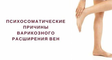 Варикоз: симптомы, причины, признаки, методы лечения и диета Картинка - Варикоз: симптомы, причины, признаки, методы лечения и диета