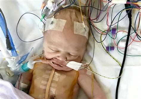 Mum Shares Heartbreaking Pictures Of Baby Recovering From Lifesaving Heart Surgery Less Than