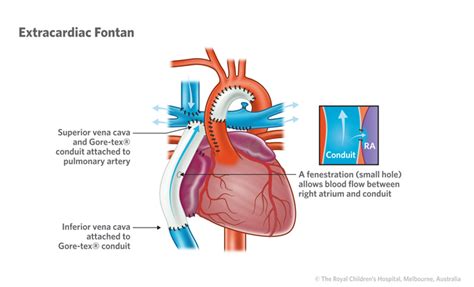 Cardiology Information For Patients And Parents About The Fontan
