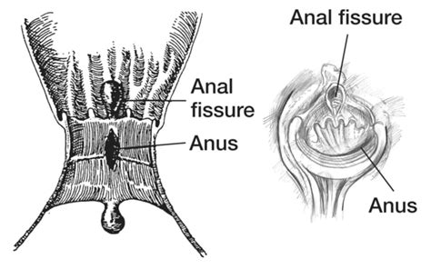 cross section and a direct view of the anus with a fissure media asset niddk