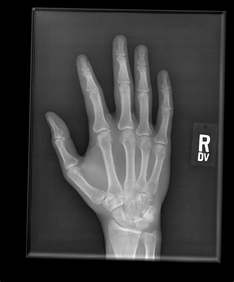 It is almost always the first imaging study ordered to evaluate for pathologies of the thorax, although further diagnostic imaging, laboratory tests. Hand x-ray. Causes, symptoms, treatment Hand x-ray