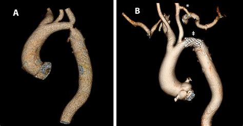 Ct Angiogram Before A And After B Carotid To Left Subclavian Artery