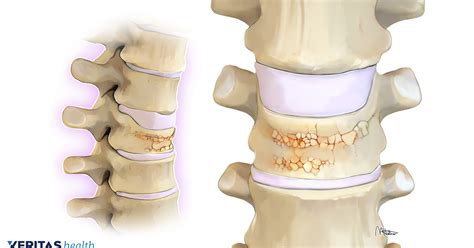 The row of connected bones that go down the middle of the back and protect the spinal cord. Chronic Pain, Osteoporosis, and Bone Density Testing