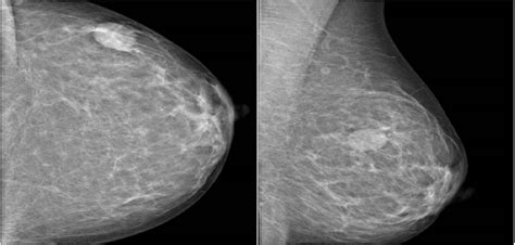 Research Suggests Novel Combination Therapy For Triple Negative Breast