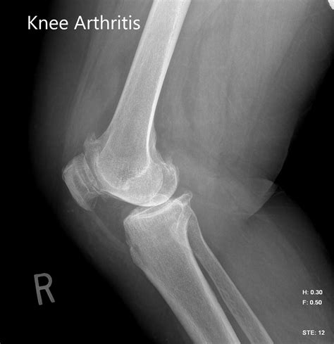 Case Study Right Knee Custom Arthroplasty In 83 Yr Old Male