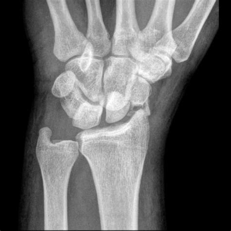 Trans Scaphoid Perilunate Dislocation Radiology Case Radiopaedia Org Radiology