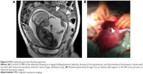 Placenta accreta is when the placenta attaches more deeply than it should. Full text Escalating placenta invasiveness: repeated ...