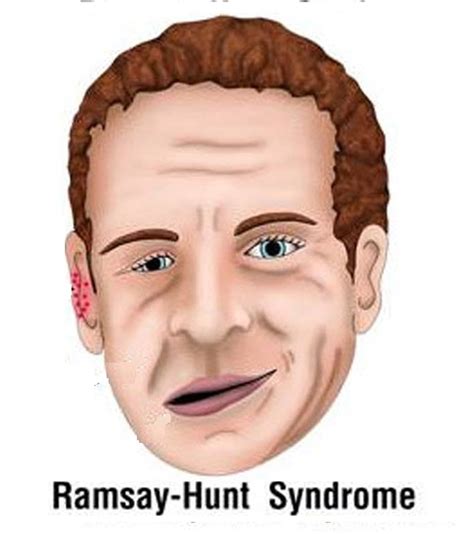 Ramsay Hunt Syndrome Causes Symptoms And Treatment