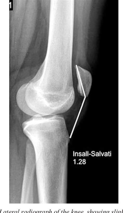 Figure 1 From Modern Treatment Of Recurrent Patellofemoral Instability