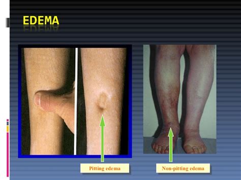 Edema