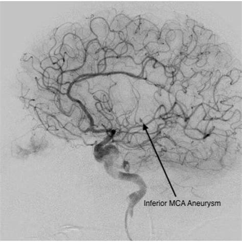 Ct Angiogram Showing Inferior Middle Cerebral Artery Aneurysm Mca Download Scientific