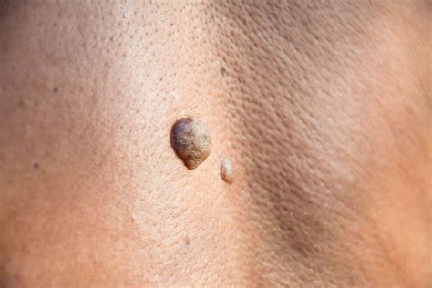 Lumps And Bumps Faciem Dermatology Clinic