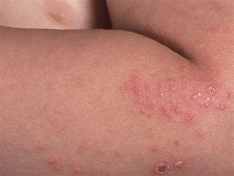 Scabies Vs Bed Bugs Key Differences Scabies Faqs