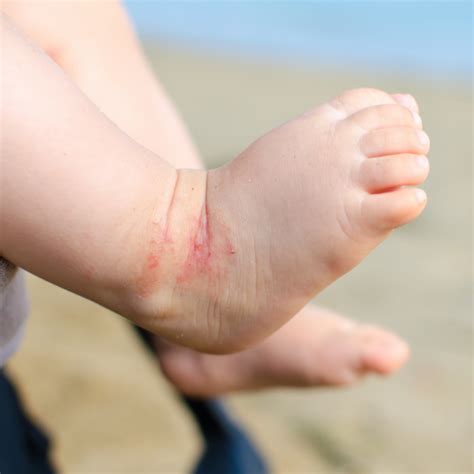 Dermatita Atopica La Copii Ce Este Si Cum O Tratam Blog Naturashop My
