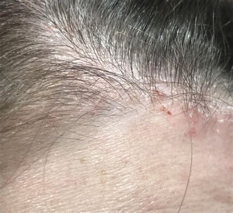 Is This Dry Scalp Psoriasis Or Something Else This Is A Photo Of The Edge Of My Scalp It Has