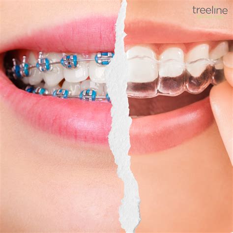 Invisalign And Braces Whats The Difference Treeline Dental Care