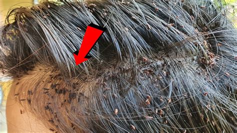 Extremely Damaged Severe Head Lice Combing On Long Hair Lady Youtube