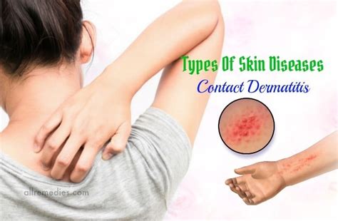 Top 7 Common Types Of Skin Diseases Causes Symptoms