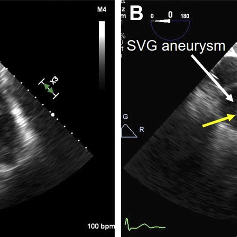 Two Dimensional Tte Modified Right Ventricular Inflow View Shows A