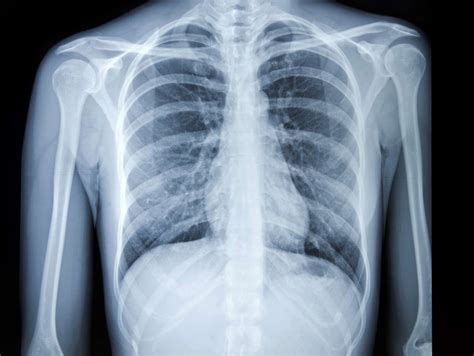 This image shows no abnormality at the left lung base. Chest X-Ray for the Diagnosis of Lung Cancer