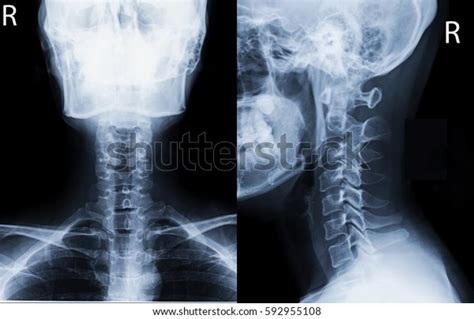 Check spelling or type a new query. Film Xray Cspine Aplateral View Show Stock Photo (Edit Now) 592955108