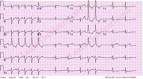 Non Sustained Ventricular Tachycardia Ecg Example 2