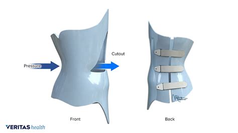 Types Of Spinal Braces Art