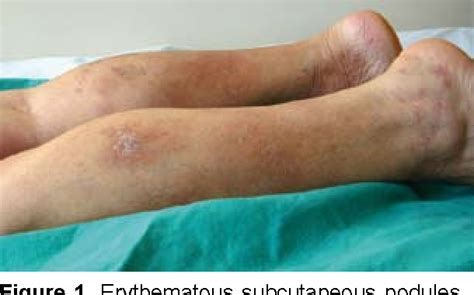 Löfgrens Syndrome Presenting With Erythema Nodosum Like Eruption