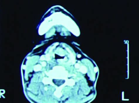 Contrast Enhanced Neck Ct Scan Axial View A Soft Tissue Mass 17 ×