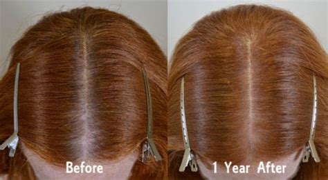 Viviscal Archives Hair Restoration Of The South