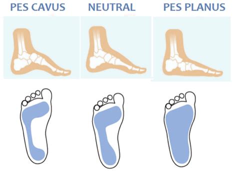 What Is Your Foot Type Moreland Podiatry
