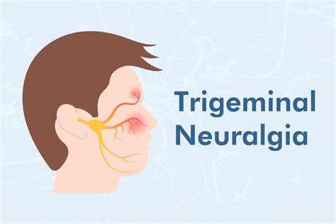 Trigeminal Neuralgia Causes Symptoms And Treatment Options