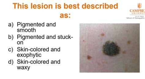 Derm 1 Benign Skin Lesions Flashcards Quizlet