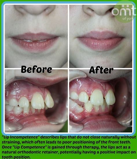 How To Correct Tongue Thrust Dom Mezquita