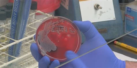 Swla Staph Mrsa Concerns What You Need To Know